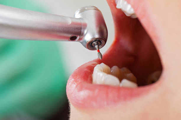 Best Emergency Wisdom Tooth Extraction in Clanton, AL